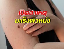 เปิดสาเหตุ โรค มะเร็งผิวหนัง  รู้เร็ว รักษาหายได้