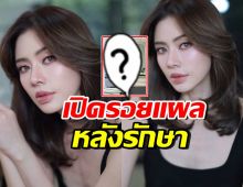เปิดภาพล่าสุด เอ๋ พรทิพย์ เห็นรอยแผลชัด หลังผ่าตัดมะเร็ง