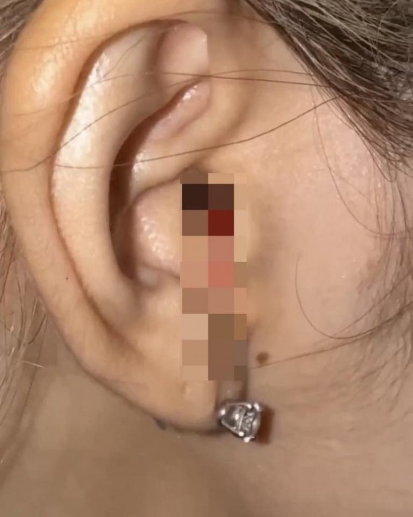 ลิซ่า อัปเดตอาการบาดเจ็บหลังเลือดไหลจากรูหู จนแฟนๆเป็นห่วง