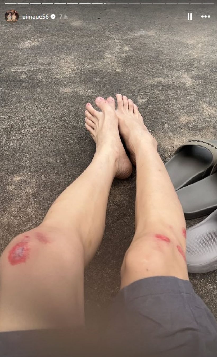 แฟนคลับใจหาย! ภาพล่าสุด เอม วิทวัส ประสบอุบัติเหตุ กลิ้งกลางถนน