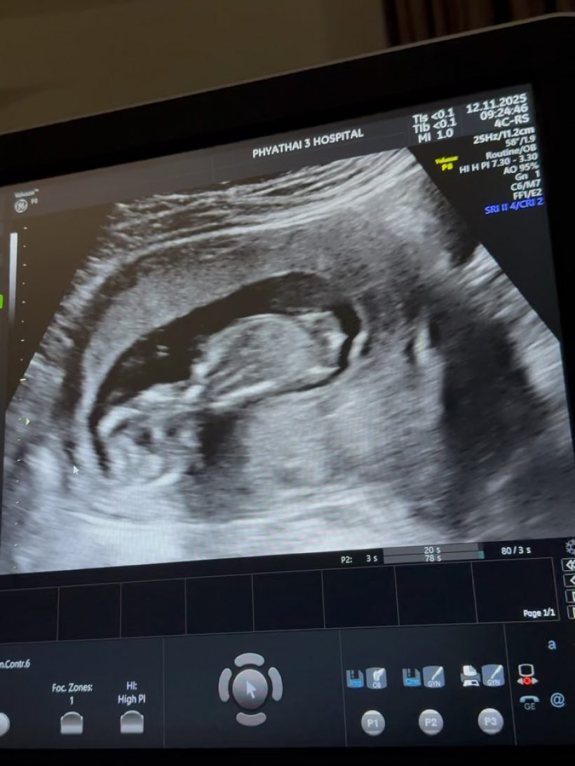 ครูก้อย เผยสาเหตุเย็บปากมดลูก ขณะตั้งครรภ์ลูกคนที่2