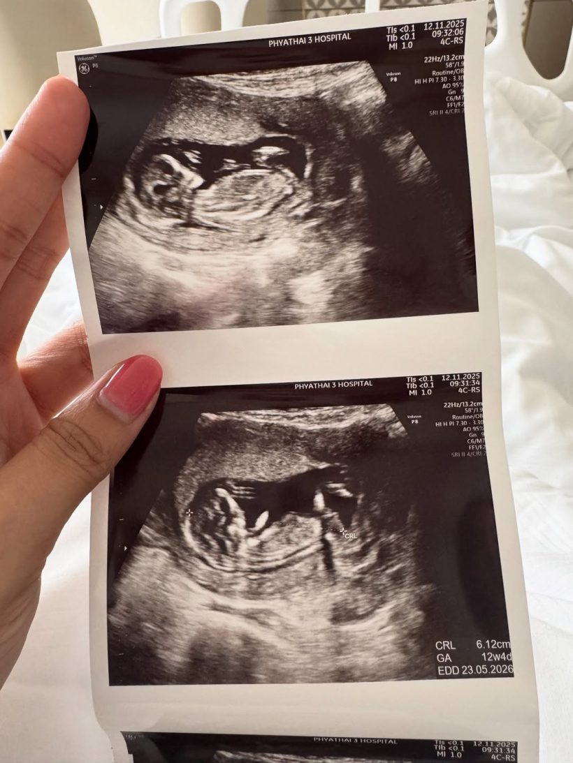 ครูก้อย เผยสาเหตุเย็บปากมดลูก ขณะตั้งครรภ์ลูกคนที่2