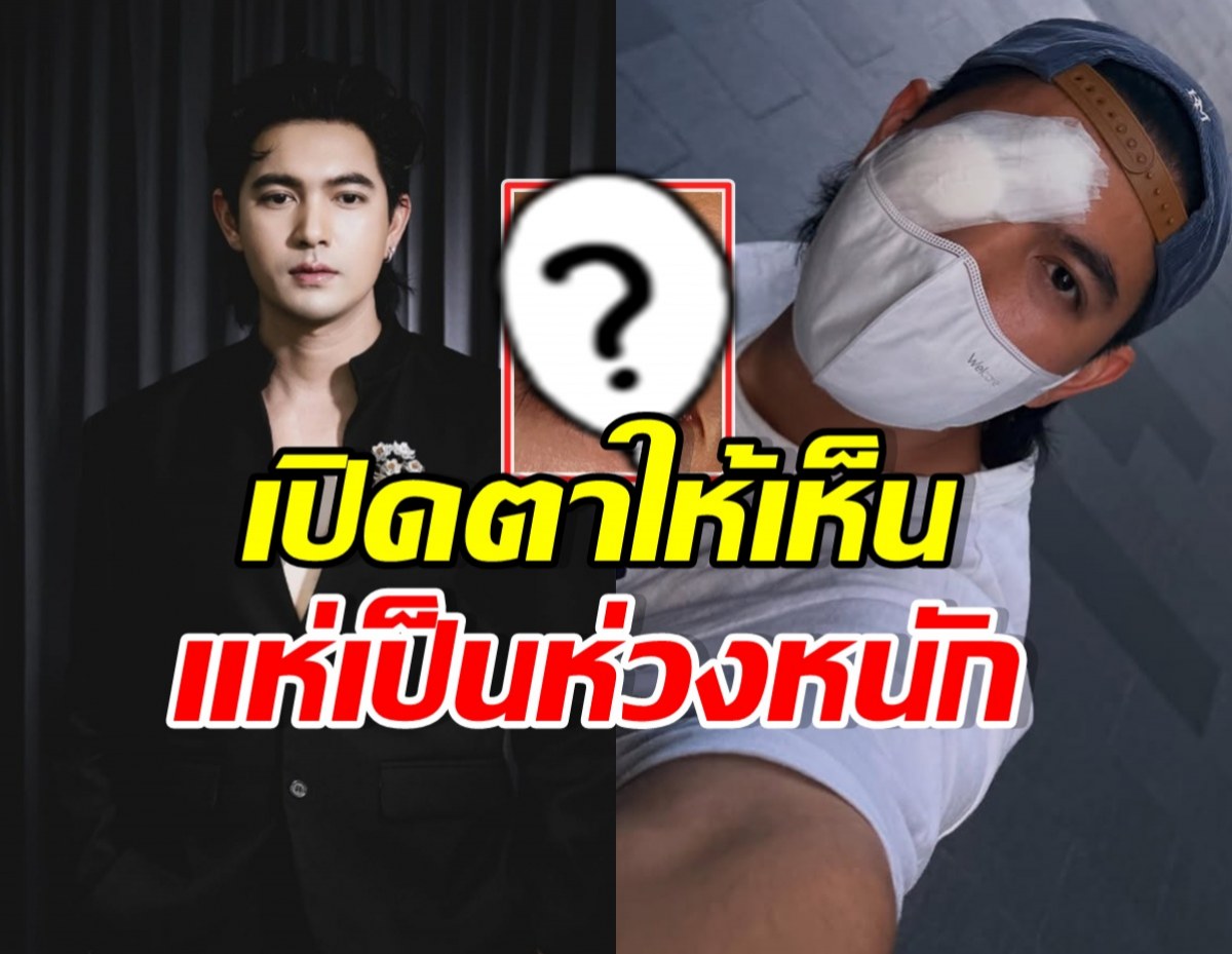 ใจหายวาบ! เข้ม หัสวีร์ เปิดภาพเผยสาเหตุ ต้องปิดตา