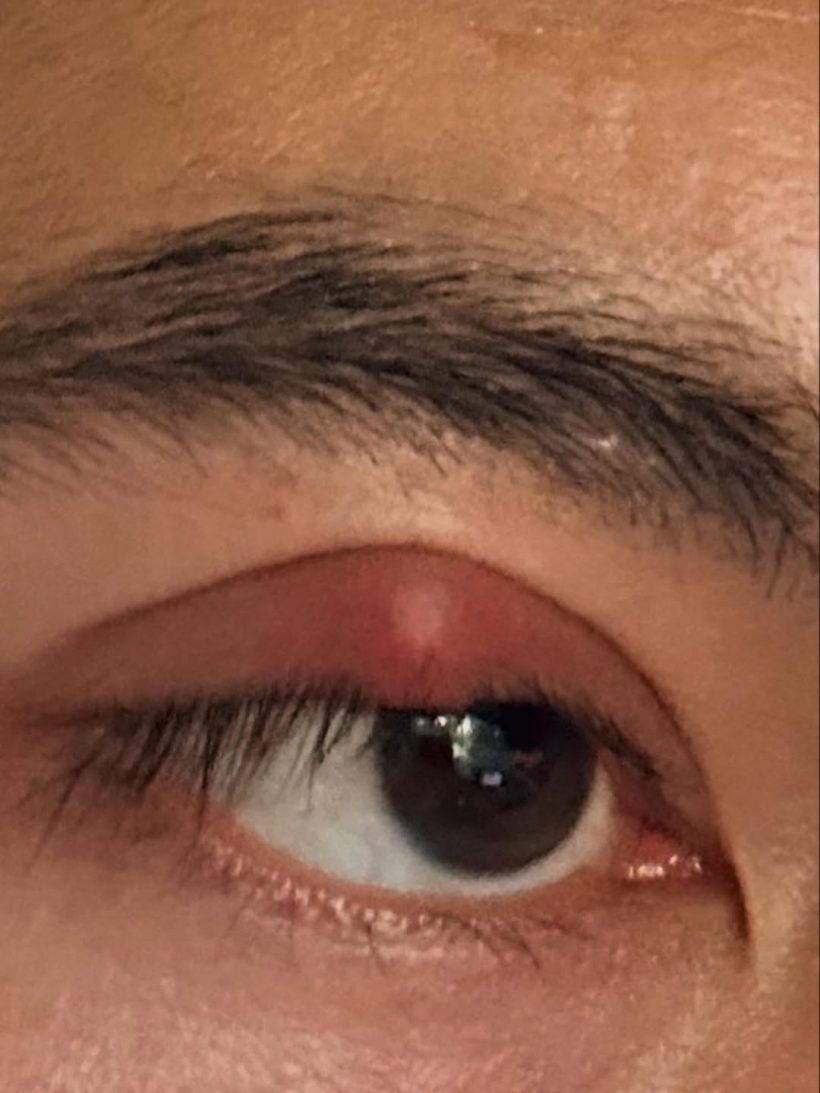 ใจหายวาบ! เข้ม หัสวีร์ เปิดภาพเผยสาเหตุ ต้องปิดตา