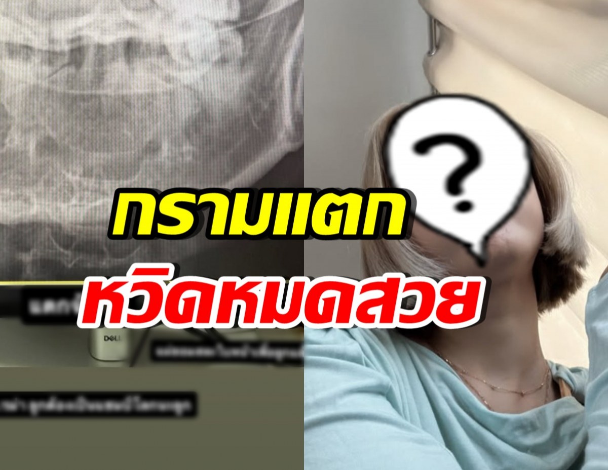 เห็นแล้วเจ็บแทน! ดาราสาวดัง กรามแตก หลังโดนหวดเข้าหน้า