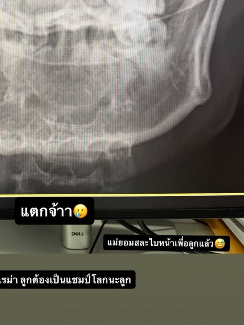 เห็นแล้วเจ็บแทน! ดาราสาวดัง กรามแตก หลังโดนหวดเข้าหน้า