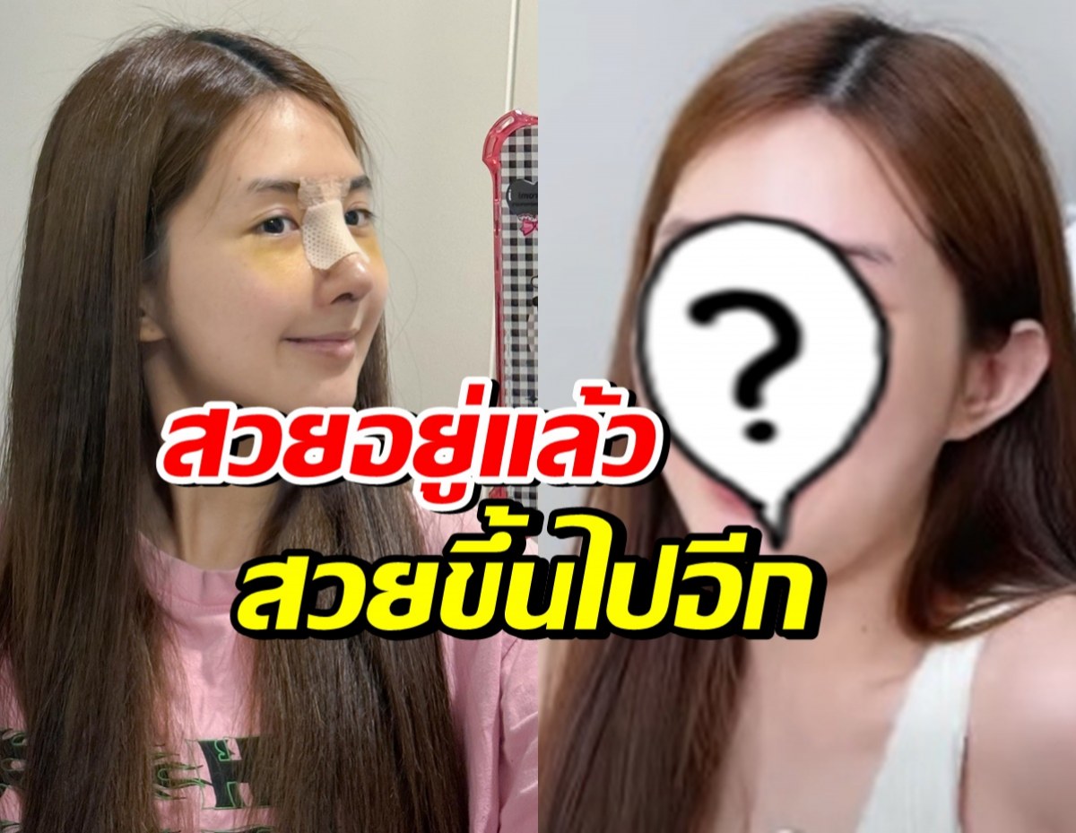 เปิดหน้าล่าสุด เบียร์ เดอะวอยซ์ หลังทำจมูก14วัน นึกว่าสาวเกาหลี