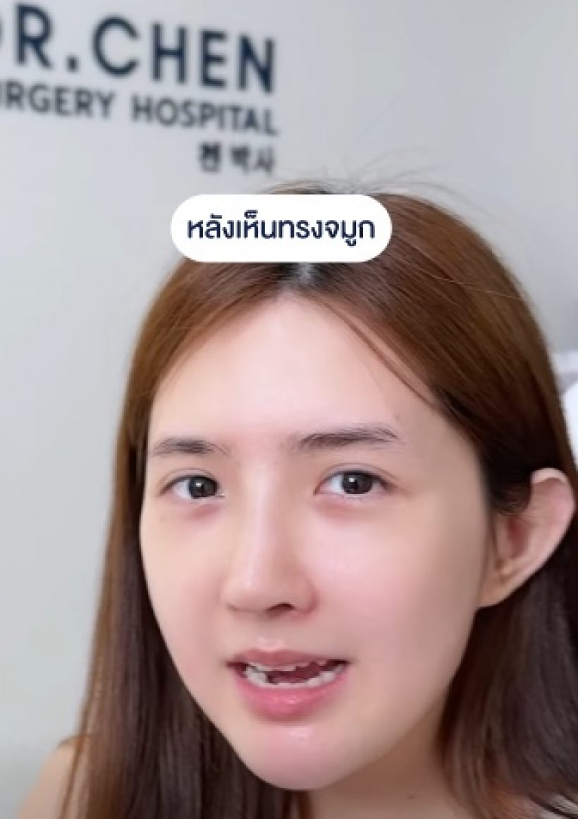เปิดหน้าล่าสุด เบียร์ เดอะวอยซ์ หลังทำจมูก14วัน นึกว่าสาวเกาหลี