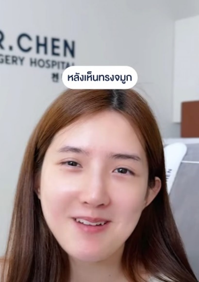 เปิดหน้าล่าสุด เบียร์ เดอะวอยซ์ หลังทำจมูก14วัน นึกว่าสาวเกาหลี