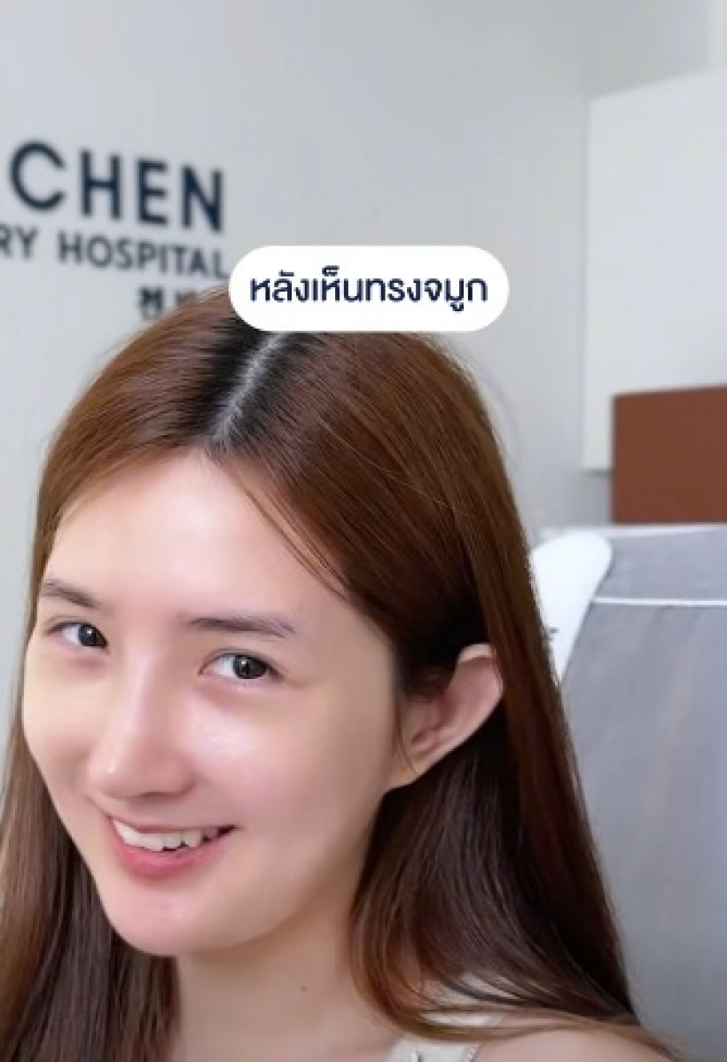 เปิดหน้าล่าสุด เบียร์ เดอะวอยซ์ หลังทำจมูก14วัน นึกว่าสาวเกาหลี
