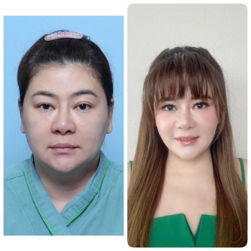 โอ๋ ภัคจิรา พลีชีพหน้าใหม่! เทียบภาพก่อนหลังศัลยกรรมที่เกาหลี
